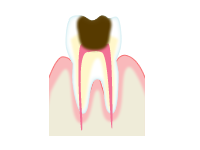 むし歯の進行とその治療方法