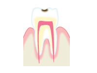むし歯の進行とその治療方法
