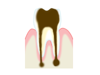 むし歯の進行とその治療方法